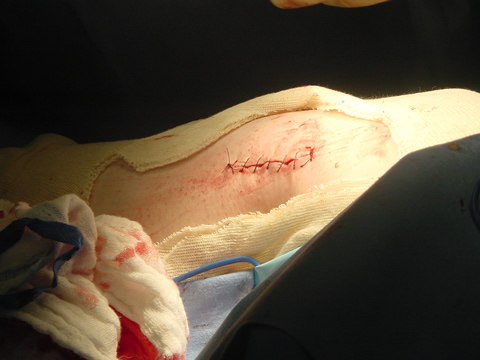 Stitches